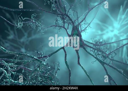 Nervenzellen, die von der Alzheimer-Krankheit betroffen sind, Illustration Stockfoto