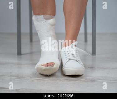 Nahaufnahme der weiblichen Beine mit Gipsabdruck. Eine Frau mit gebrochenem Bein sitzt auf einem Stuhl Stockfoto