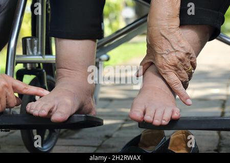 Ältere Frau geschwollene Füße drücken Sie die Taste Test auf Rollstuhl Stockfoto