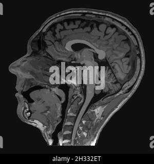 Realistisches sagittales Bild des männlichen Kopfes mit CT-Scan, MRT-Magnetresonanztomographie-Schicht des Kopfes. Isoliert auf dunklem Hintergrund. Vektorgrafik. Stock Vektor