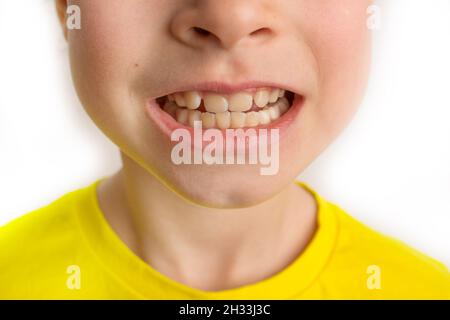 Kinder krumme Zähne, Kinderzahnheilkunde. Schiefe Zähne aus der Nähe. Stockfoto