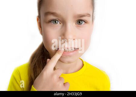 Kinder krumme Zähne, Kinderzahnheilkunde. Schiefe Zähne aus der Nähe. Stockfoto