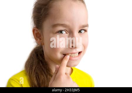 Kinder krumme Zähne, Kinderzahnheilkunde. Schiefe Zähne aus der Nähe. Stockfoto