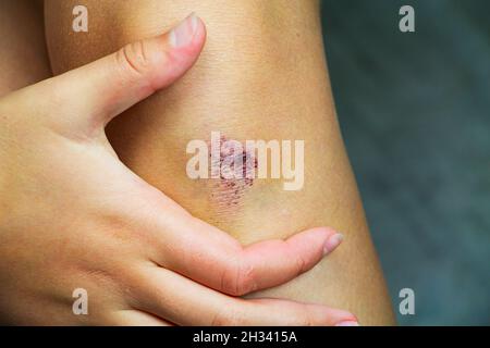 Das gequetschte Knie einer Frau, selektiver Fokus, Sportverletzungen. Ein Abrieb auf der Haut Stockfoto