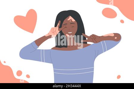 Mädchen mit Hautproblemen Vitiligo Vektor Illustration. Cartoon junge glückliche Frau Charakter mit Depigmentation Patches lächelnd, schönen Körper positive Modell winken. Internationales Vitiligo Tageskonzept Stock Vektor