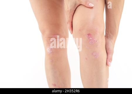 Kniegelenkerguss (Wasser auf dem Knie). Akute psoriatische Arthritis, Arthrose, Meniskusverletzung. Überschüssige Synovialflüssigkeit im und um das linke Kniegelenk Stockfoto