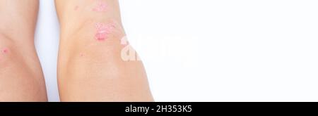 Kniegelenkerguss (Wasser auf dem Knie) akute psoriatische Arthritis, Arthrose, Meniskusriss. Überschüssige Synovialflüssigkeit im und um das Kniegelenk Stockfoto