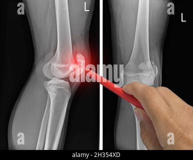 Nahaufnahme Röntgenknee AP-Lateral zeigt Fraktur Patella oder Kniekappe. Schmerzen bei einem Mann, Arzt hält einen roten Stift Punkt , Symptome medizinische Versorgung conce Stockfoto
