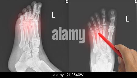 Nahaufnahme Röntgenfuß AP-Lateral zeigt Fraktur 3.,4. Metatarsalknochen, Arzt hält einen roten Stift Punkt , Symptome medizinisches Gesundheitskonzept. Stockfoto