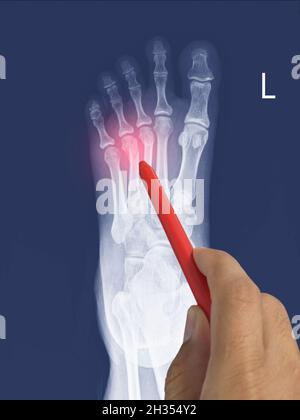 Nahaufnahme Röntgenfuß AP zeigt Bruch 3.,4. Metatarsalknochen, Arzt hält einen roten Stift Punkt , Symptome medizinisches Gesundheitskonzept. Stockfoto