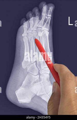Nahaufnahme Röntgenfuß lateral zeigt Bruch 3.,4. Metatarsalknochen, Arzt hält einen roten Stift Punkt , Symptome medizinisches Gesundheitskonzept. Stockfoto