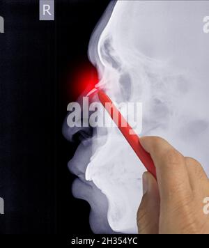 Nahaufnahme Röntgenaufnahme Nasenbein seitlich zeigt Bruch Nasenbein, Arzt hält einen roten Stift Punkt, Symptome medizinisches Gesundheitskonzept. Stockfoto