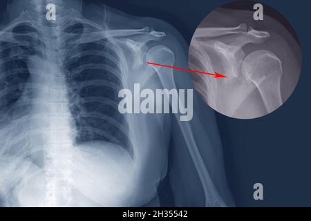 Röntgenschulterfraktur posteriore Hälfte des Glinoidals mit posteriorer Dislokation des Knochenfragmentes. Unregelmäßiger transversaler Bruch am Körper der Scapula. Stockfoto