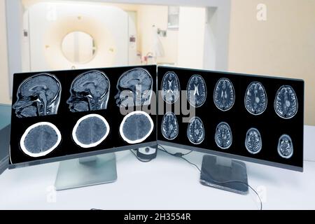 Nahaufnahme des CT-Scan-Kontrollraums und Darstellung des Hirnbild-Meningioms im Gehirn-CT-Scan-Raum im Hintergrund, medizinische Versorgung und Technologiekonzept. Stockfoto