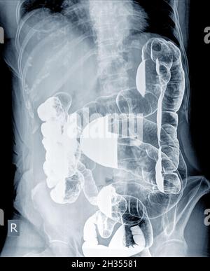 Radiologische Untersuchung zur Suche nach Darmanomalien durch Einlauf des Bariumpulvers und der Luft in den Anus. Dann wurde eine Röntgenaufnahme durchgeführt. Medizinisches Bildkonzept. Stockfoto
