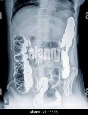 Radiologische Untersuchung zur Suche nach Darmanomalien durch Einlauf des Bariumpulvers und der Luft in den Anus. Dann wurde eine Röntgenaufnahme durchgeführt. Medizinisches Bildkonzept. Stockfoto