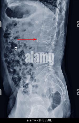 Film X-ray LS-Wirbelsäule Seitenansicht zeigt Burst Fracture des L2-Wirbelkörpers mit schwerem Wirbelkollaps, medizinisches Bildkonzept. Stockfoto