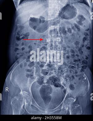 Film X-ray LS-Wirbelsäule AP-Ansicht zeigt Burst Fracture des L2-Wirbelkörpers mit schwerem Wirbelkollaps, medizinisches Bildkonzept. Stockfoto