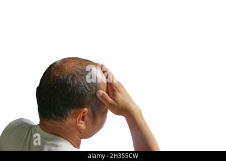 Nahaufnahme hinter den Kulissen eines kahlen Mannes, der aufgrund von Kopfschmerzen oder Gesundheitsstress sitzt und seinen Kopf hält. Stockfoto