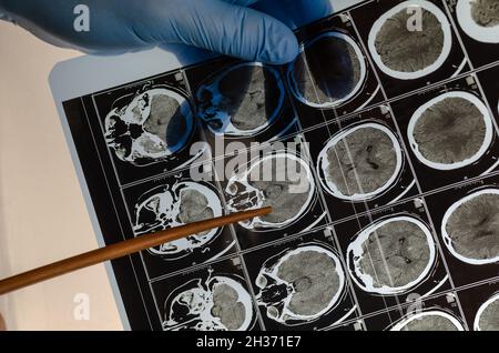 Arzt mit blauen medizinischen Handschuhen zeigt einen Zeiger auf eine Röntgenaufnahme des Gehirns einer Person. Gesundheit und Medizin. Selektiver Fokus. Stockfoto