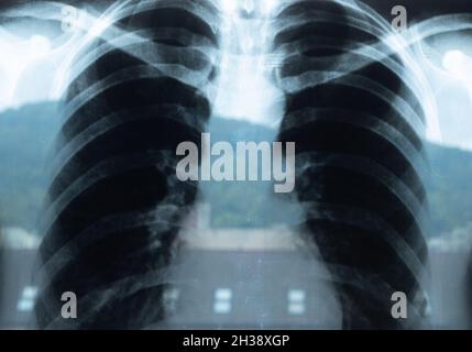 Thoraxradiographie, Röntgenaufnahme der Lunge nach einer Covid 19-Infektion Stockfoto
