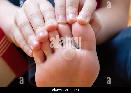 Fuß mit Problemstellen auf der Haut, trockener Mais. Plantar Warze des Fußes. Ungesunde Fußhaut Konzept. Kosmetik- und Hautpflegekonzept Stockfoto