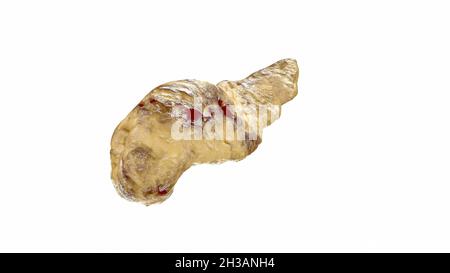 Pankreatitis Krankheit der menschlichen Bauchspeicheldrüse auf weiß isoliert. Akute hämorrhagische Pankreatitis mit fettiger Nekrose der Bauchspeicheldrüse. 3d-Illustration Stockfoto