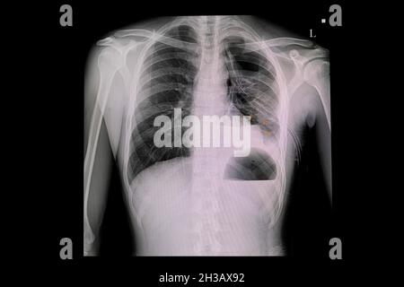 Röntgenbrust eines Patienten mit linkem ICD und moderater Menge an Links-Hydro-Pneumothorax. Stockfoto