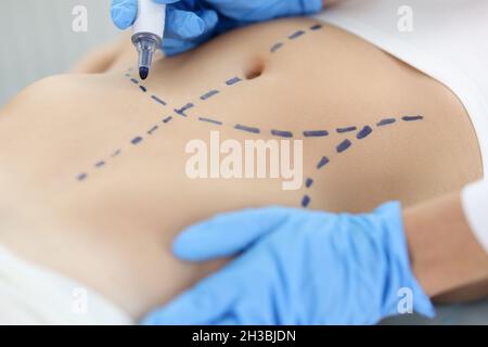 Arzt plastischer Chirurg, der präoperative Markierungen auf der Haut des Patienten abdomen closeup zeichnet Stockfoto