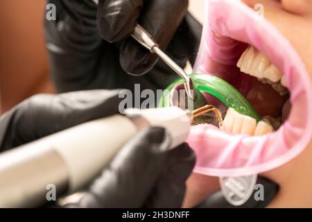 Nahaufnahme der Zahnstein Zahnstein Entferner Werkzeug Stockfoto