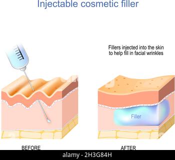 Kosmetischer Füllstoff injizierbar. Haut mit Falten vor der Injektion von Hyaluronsäure und Hautschichten nach medizinischem Verfahren. Anti-Aging-Therapie. Fille Stock Vektor