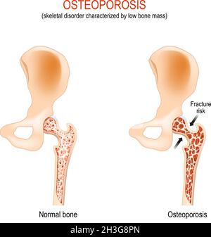 Osteoporose. Normales Hüftgelenk und Knochen mit Skelettstörung, die durch geringe Knochenmasse gekennzeichnet ist. Femurfrakturrisiko. Differenz und Vergleich Stock Vektor