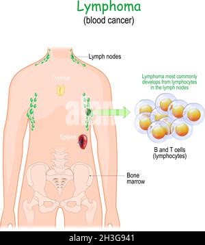 Lymphom oder Blutkrebs. Körper des Menschen mit Lymphsystem. Nahaufnahme von weißen Blutkörperchen. vektorgrafik. Stock Vektor