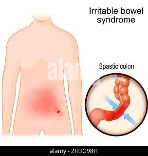 Reizdarmsyndrom. IBS oder Schleimkolitis ist eine funktionelle Magen-Darm-Erkrankung. Körper des Menschen mit Bauchschmerzen Bereiche Stock Vektor