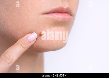 Nahaufnahme des Maulwurfs auf dem Gesicht der Frau. Geburtszeichen oder Nevus. Speicherplatz kopieren Stockfoto