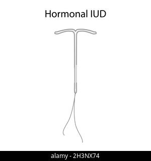 Hormonelle intrauterine Geräte, Illustration Stockfoto
