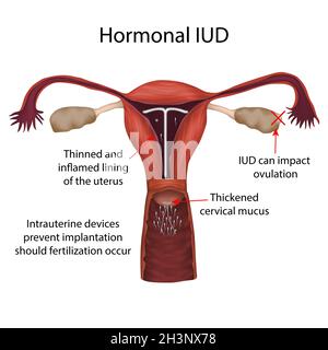 Hormonelle IUD, Illustration Stockfoto