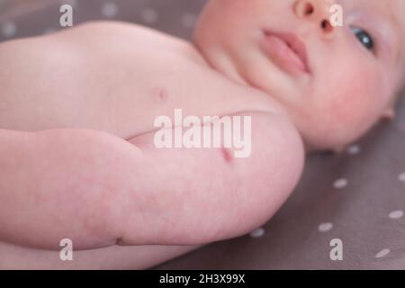 Neugeborene mit Spuren einer BCG-Impfung oder des TB-Impfstoffs am Arm. Stockfoto