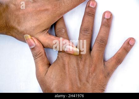 Ein Mensch, der seine großen und schmutzigen Nägel auf weißem Hintergrund zeigt Stockfoto