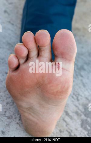 Fußpilz - Tinea pedis, Pilzinfektion oder Fußsohle mit Dermatitis, Subjekt ist weicher Fokus Stockfoto