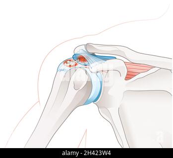 Abbildung mit kalzifischer Sehnenentzündung und kalzifischer Bursitis Stockfoto