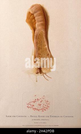 Dissektion des Ileums mit Anzeichen von Cholera asiatica, mit einem Detail unten, das Bakterienzellen unter einem Mikroskop zeigt. Chromolithograph von W. Gummelt, ca. 1897. Stockfoto