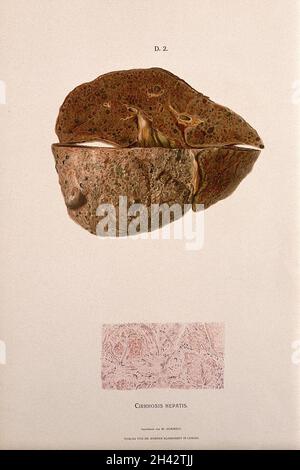 Sektionen einer erkrankten Leber, einschließlich eines Abschnitts unter dem Mikroskop, der Symptome einer Zirrhose zeigt. Chromolithograph von W. Gummelt, ca. 1897. Stockfoto