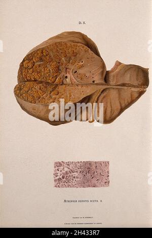 Dissektion einer erkrankten Leber, einschließlich eines unter dem Mikroskop sichtbaren Abschnitts, der Symptome einer Atrophia heptis acuta zeigt. Chromolithograph von W. Gummelt, ca. 1897. Stockfoto
