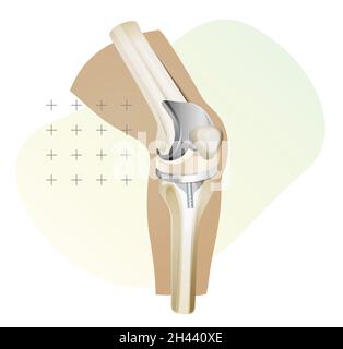 Kniegelenkersatz-Chirurgie - Illustration als EPS 10-Datei Stock Vektor
