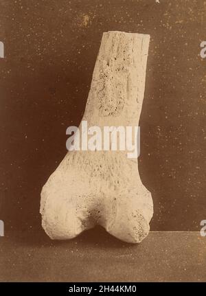 Unteres Ende des rechten Oberschenkels mit pulmonaler Osteo-Arthropathie betroffen (posteriore Ansicht) Stockfoto