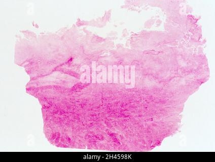 Amöbiasis: Amöbenabszess in der Leber Stockfoto