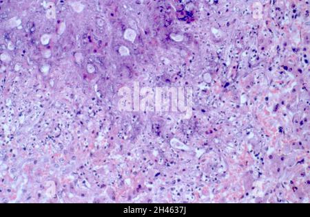 Amöbiasis: Amöbenabszess in der Leber Stockfoto