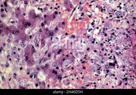 Amöbiasis: Amöbenabszess in der Leber Stockfoto