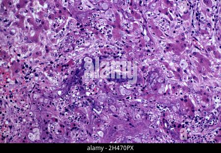 Amöbiasis: Amöbenabszess in der Leber Stockfoto